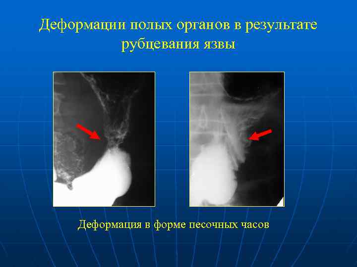 Деформации полых органов в результате рубцевания язвы Деформация в форме песочных часов 