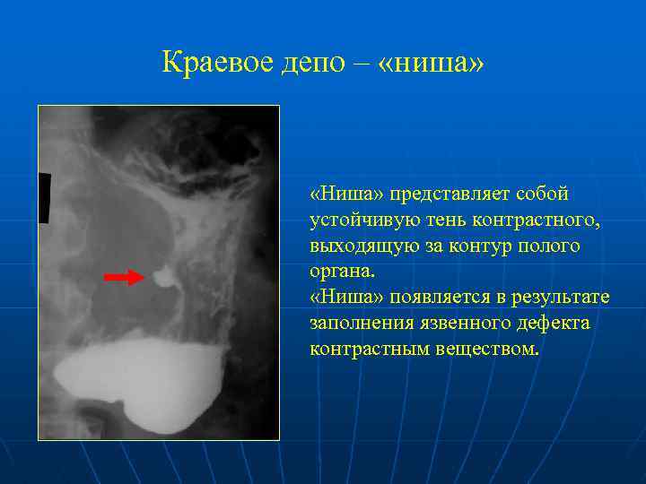 Краевое депо – «ниша» «Ниша» представляет собой устойчивую тень контрастного, выходящую за контур полого