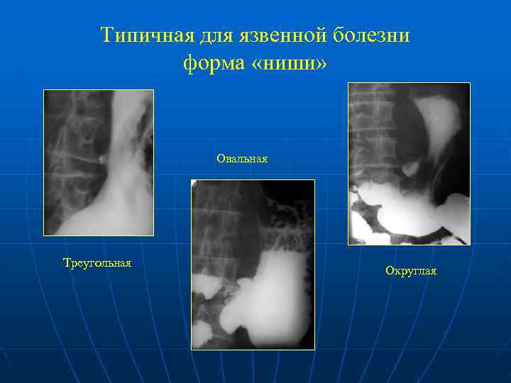 Типичная для язвенной болезни форма «ниши» Овальная Треугольная Округлая 