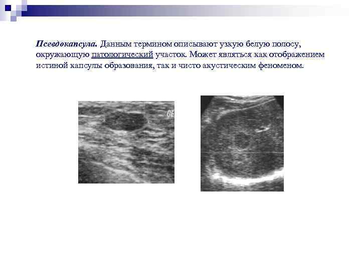 Псевдокапсула. Данным термином описывают узкую белую полосу, окружающую патологический участок. Может являться как отображением