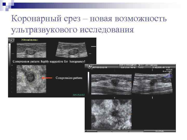 Коронарный срез – новая возможность ультразвукового исследования 