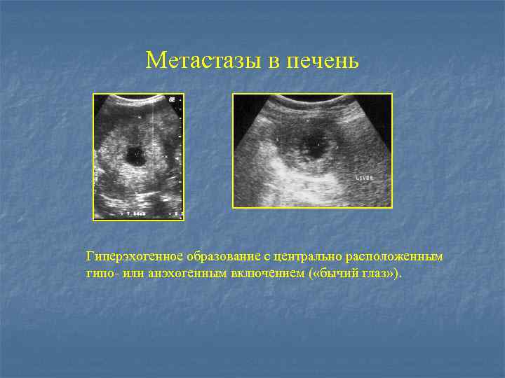 Метастазы в печень Гиперэхогенное образование с центрально расположенным гипо- или анэхогенным включением ( «бычий