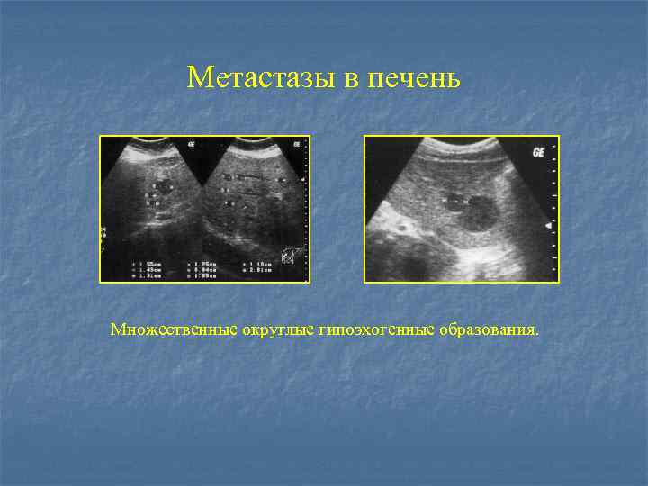 Как выглядят метастазы в печени на узи на фото