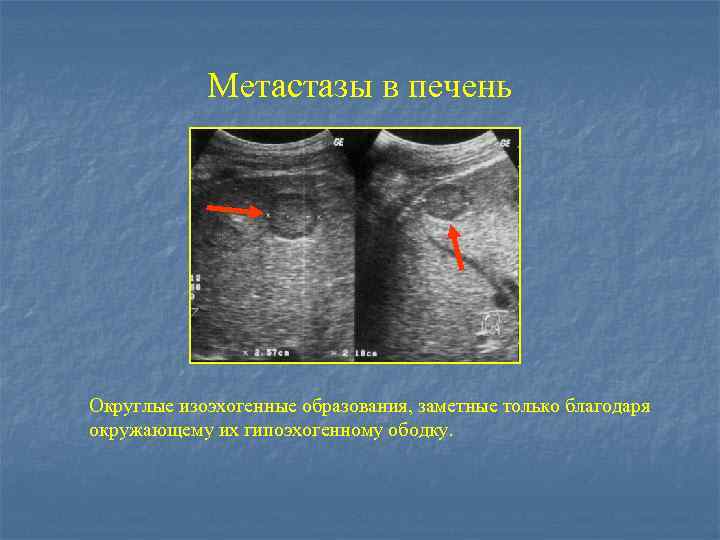 Метастазы в печень Округлые изоэхогенные образования, заметные только благодаря окружающему их гипоэхогенному ободку. 