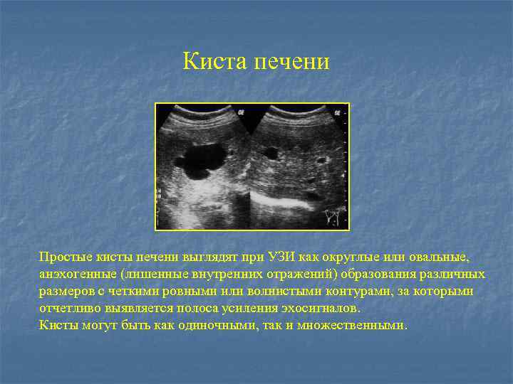 Эхинококковая киста печени в ультразвуковом изображении характеризуется