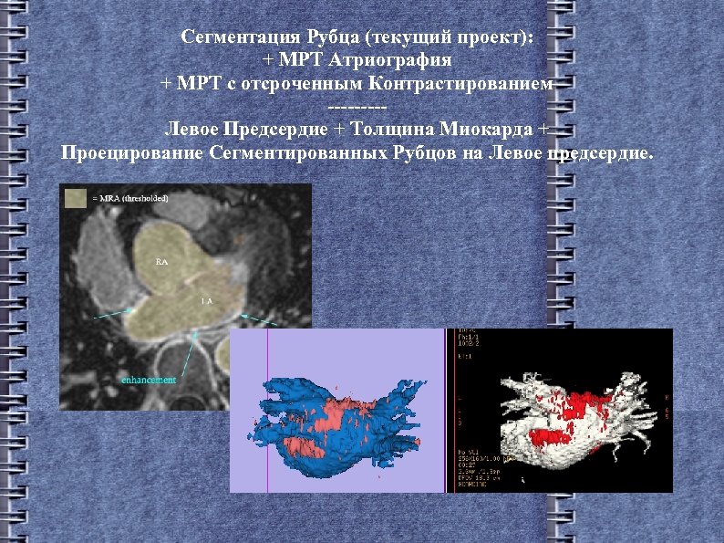 Сегментация Рубца (текущий проект): + МРТ Атриография + МРТ с отсроченным Контрастированием ----Левое Предсердие