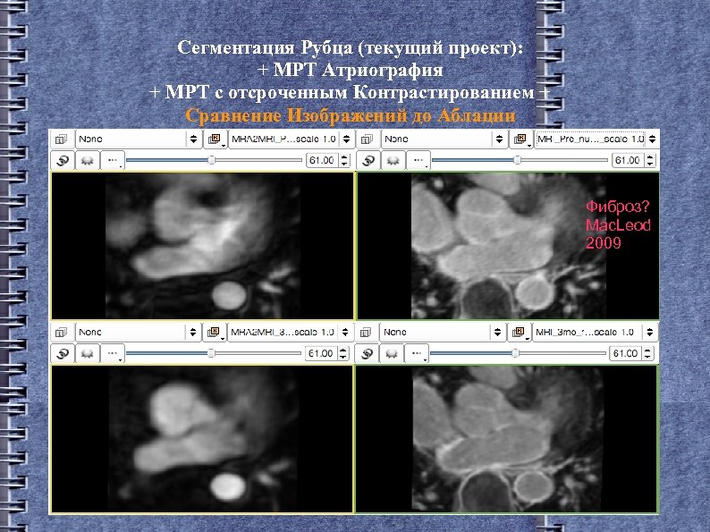 Сегментация Рубца (текущий проект): + МРТ Атриография + МРТ с отсроченным Контрастированием + Сравнение