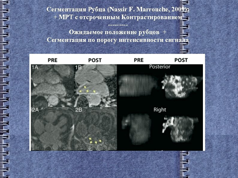 Сегментация Рубца (Nassir F. Marrouche, 2009): + МРТ с отсроченным Контрастированием ----Ожидаемое положение рубцов