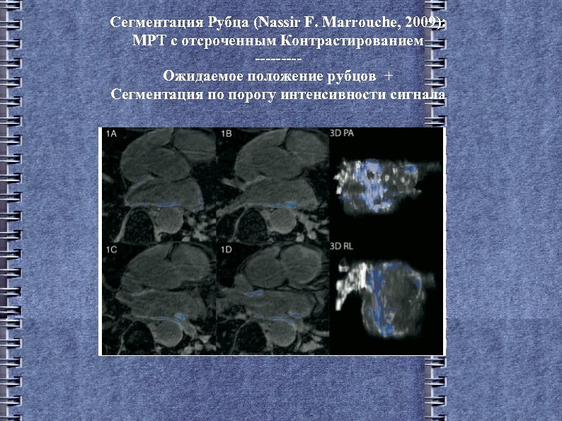 Сегментация Рубца (Nassir F. Marrouche, 2009): МРТ с отсроченным Контрастированием ----Ожидаемое положение рубцов +