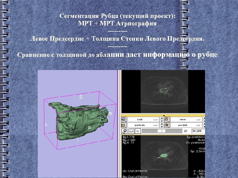 Сегментация Рубца (текущий проект): МРТ + МРТ Атриография ----Левое Предсердие + Толщина Стенки Левого