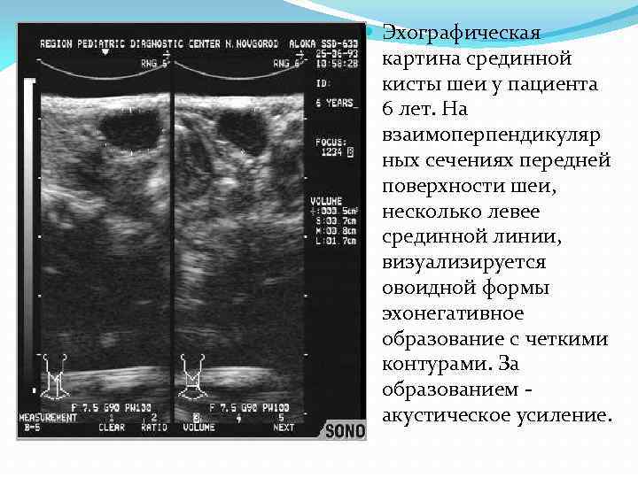 Эхографическая картина. Срединная киста шеи на УЗИ. Срединная киста шеи заключение УЗИ.