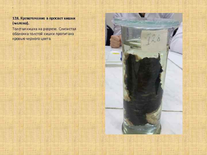 . 128. Кровотечение в просвет кишки (мелена). Толстая кишка на разрезе. Слизистая оболочка толстой