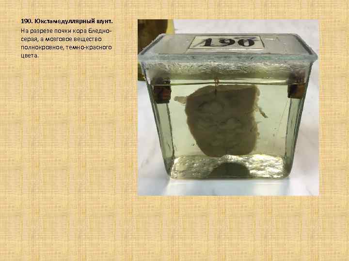  190. Юкстамедуллярный шунт. На разрезе почки кора бледносерая, а мозговое вещество полнокровное, темно-красного