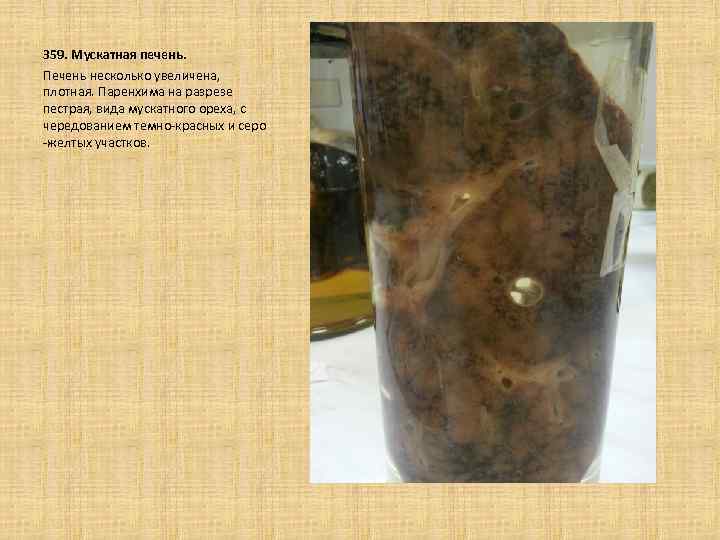  359. Мускатная печень. Печень несколько увеличена, плотная. Паренхима на разрезе пестрая, вида мускатного