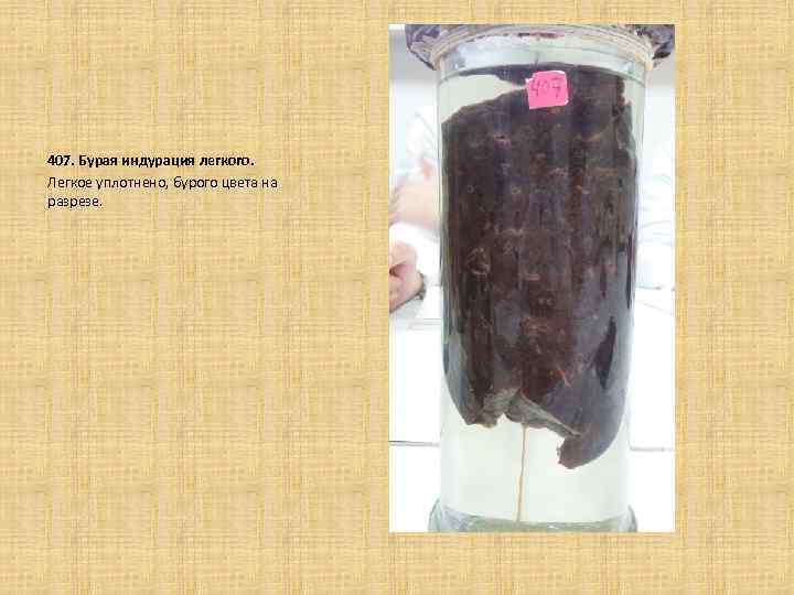  407. Бурая индурация легкого. Легкое уплотнено, бурого цвета на разрезе. 