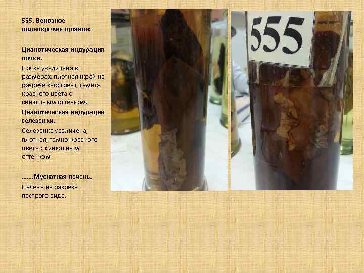 555. Венозное полнокровие органов: Цианотическая индурация почки. Почка увеличена в размерах, плотная (край на