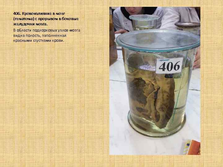  406. Кровоизлияние в мозг (гематома) с прорывом в боковые желудочки мозга. В области