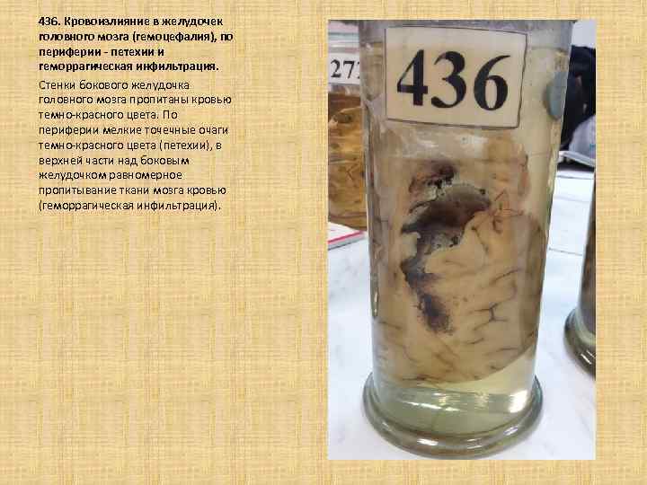 436. Кровоизлияние в желудочек головного мозга (гемоцефалия), по периферии - петехии и геморрагическая инфильтрация.