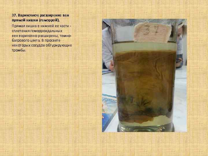  37. Варикозное расширение вен прямой кишки (геморрой). Прямая кишка в нижней ее части