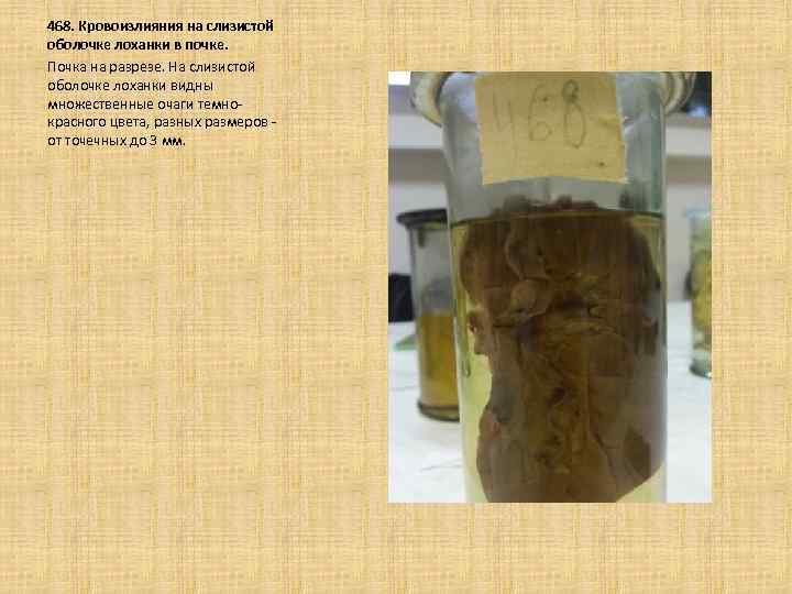 468. Кровоизлияния на слизистой оболочке лоханки в почке. Почка на разрезе. На слизистой оболочке