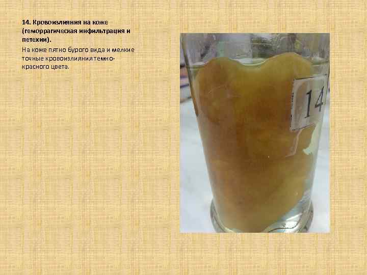  14. Кровоизлияния на коже (геморрагическая инфильтрация и петехии). На коже пятно бурого вида