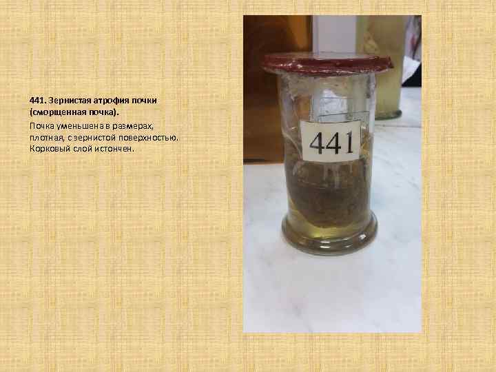  441. Зернистая атрофия почки (сморщенная почка). Почка уменьшена в размерах, плотная, с зернистой