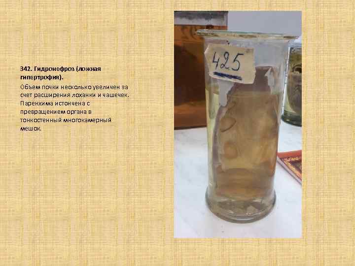  342. Гидронефроз (ложная гипертрофия). Объем почки несколько увеличен за счет расширения лоханки и