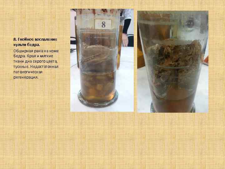 8. Гнойное воспаление культи бедра. Обширная рана на коже бедра. Края и мягкие ткани