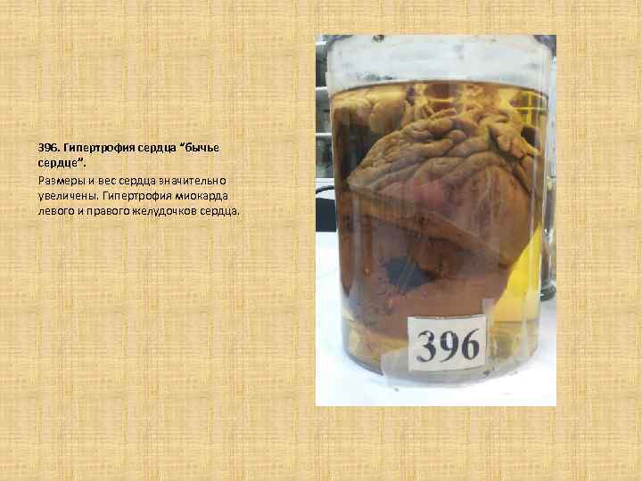  396. Гипертрофия сердца “бычье сердце”. Размеры и вес сердца значительно увеличены. Гипертрофия миокарда