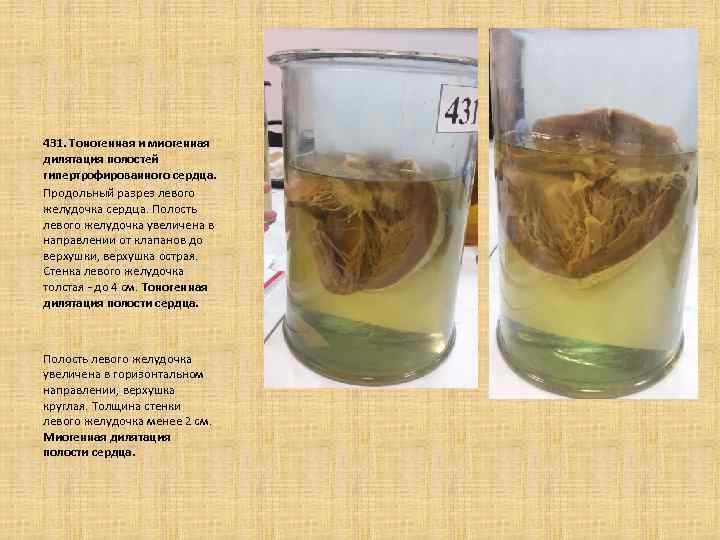  431. Тоногенная и миогенная дилятация полостей гипертрофированного сердца. Продольный разрез левого желудочка сердца.