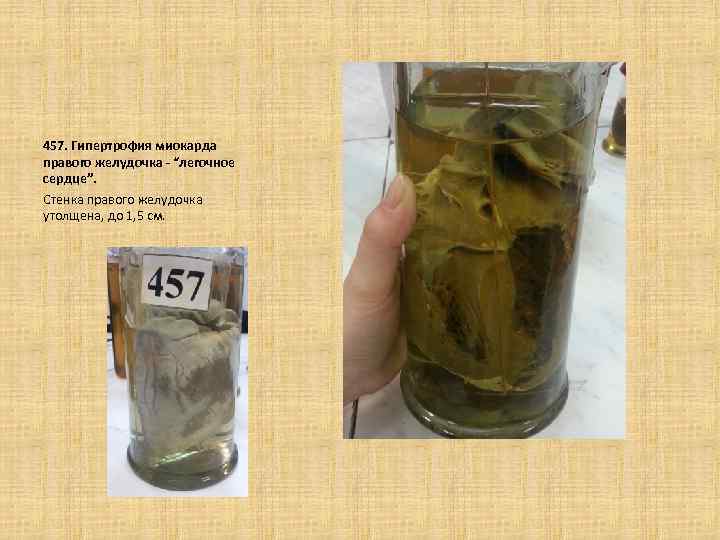  457. Гипертрофия миокарда правого желудочка - “легочное сердце”. Стенка правого желудочка утолщена, до