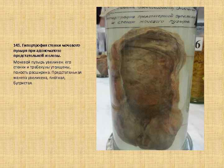  145. Гипертрофия стенки мочевого пузыря при аденоматозе предстательной железы. Мочевой пузырь увеличен: его