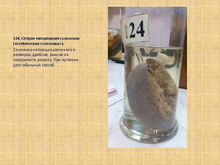 124. Острая гиперплазия селезенки ( «септическая селезенка» ). Селезенка несколько увеличена в размерах, дряблая,