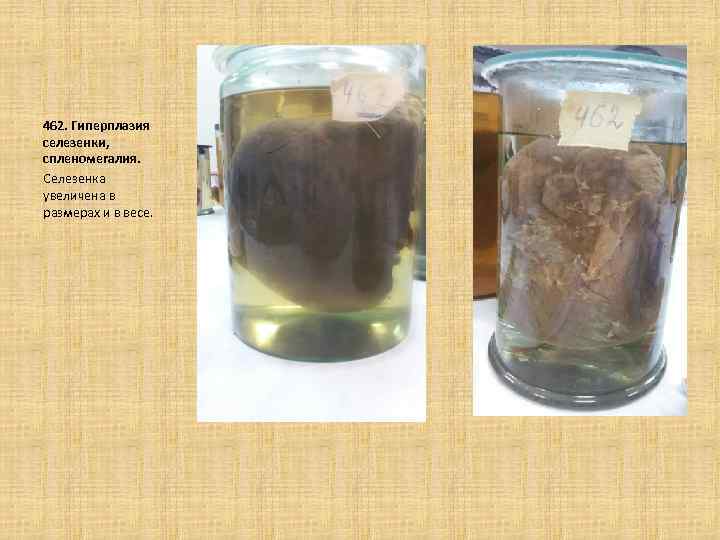 462. Гиперплазия селезенки, спленомегалия. Селезенка увеличена в размерах и в весе. 