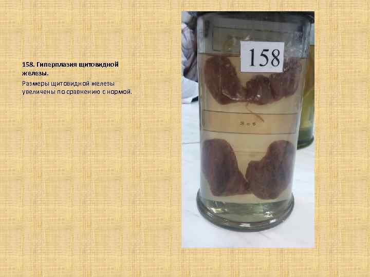 158. Гиперплазия щитовидной железы. Размеры щитовидной железы увеличены по сравнению с нормой. 