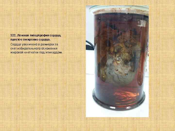  522. Ложная гипертрофия сердца, простое ожирение сердца. Сердце увеличено в размерах за счет