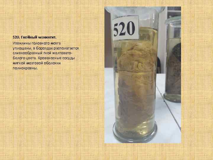 520. Гнойный менингит. Извилины головного мозга уплощены, в бороздах располагается сливкообразный гной желтоватобелого цвета.