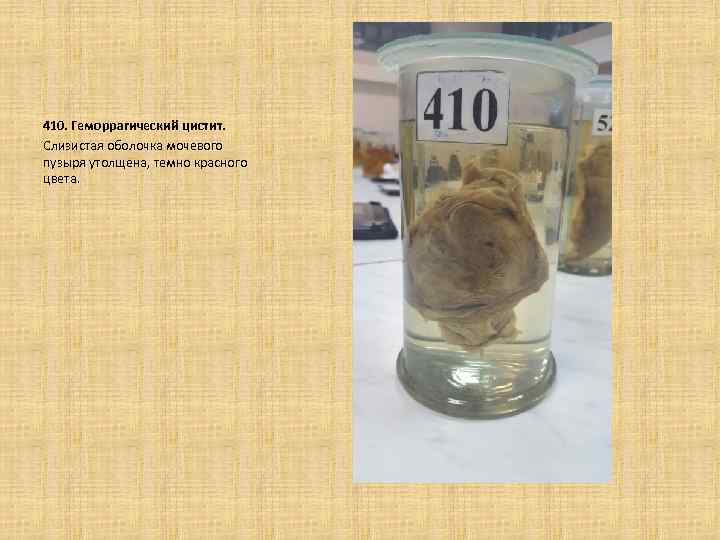 410. Геморрагический цистит. Слизистая оболочка мочевого пузыря утолщена, темно красного цвета. 
