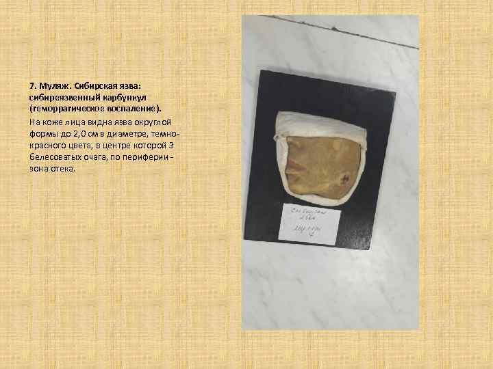 7. Муляж. Сибирская язва: сибиреязвенный карбункул (геморрагическое воспаление). На коже лица видна язва округлой