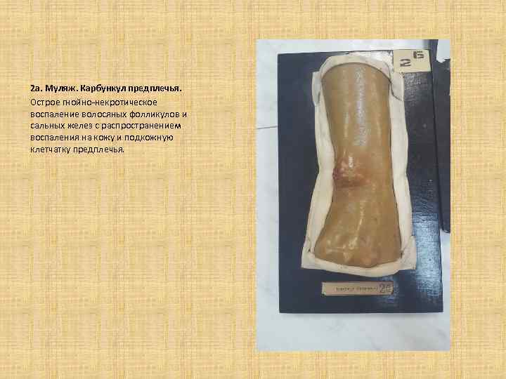 2 а. Муляж. Карбункул предплечья. Острое гнойно-некротическое воспаление волосяных фолликулов и сальных желез с