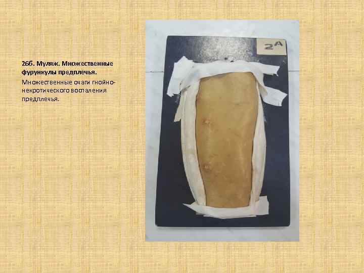 26 б. Муляж. Множественные фурункулы предплечья. Множественные очаги гнойнонекротического воспаления предплечья. 