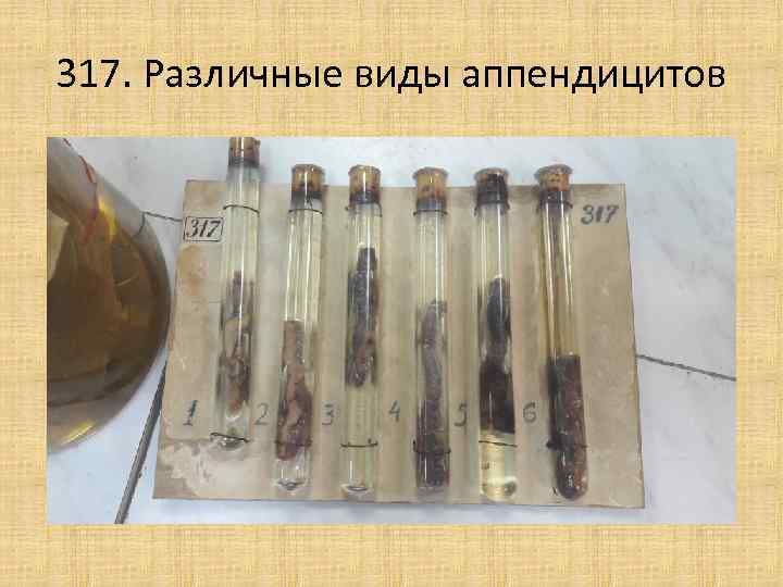 317. Различные виды аппендицитов 