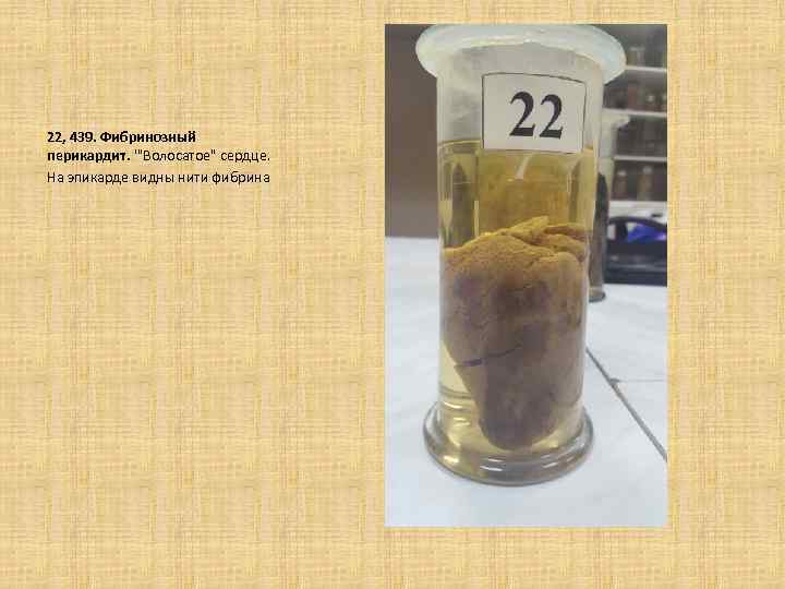 22, 439. Фибринозный перикардит. '