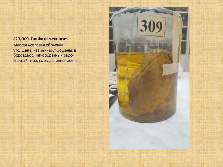 520, 309. Гнойный менингит. Мягкая мозговая оболочка утолщена, извилины уплощены, в бороздах сливкообразный серожелтый