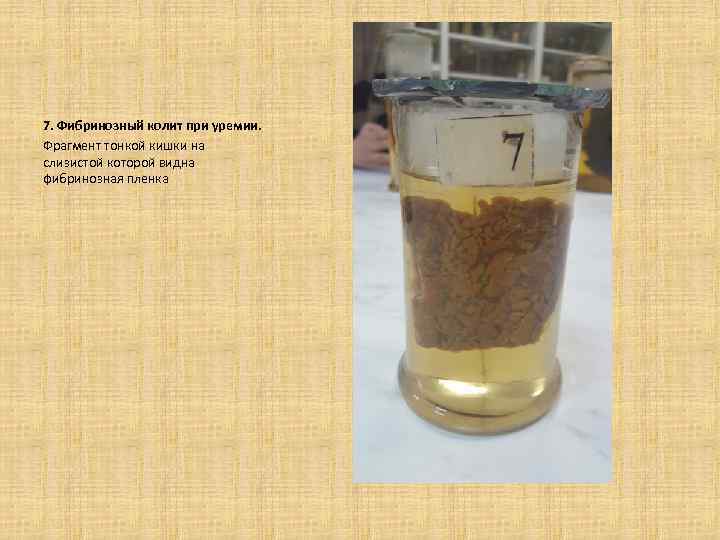 7. Фибринозный колит при уремии. Фрагмент тонкой кишки на слизистой которой видна фибринозная пленка
