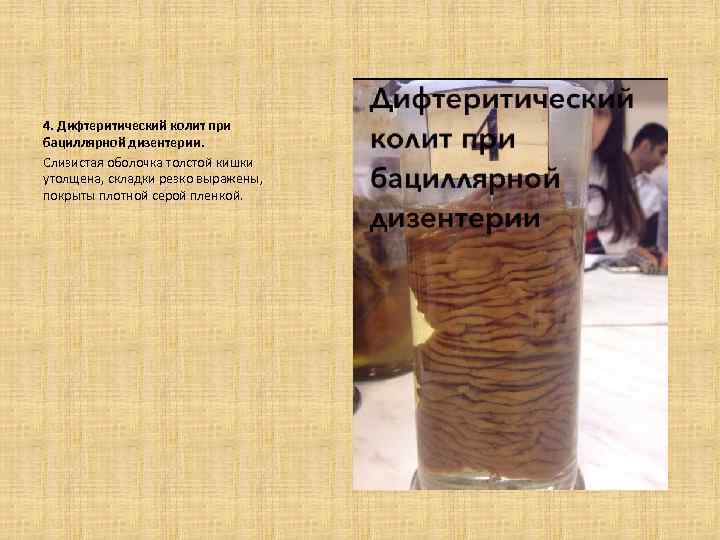 4. Дифтеритический колит при бациллярной дизентерии. Слизистая оболочка толстой кишки утолщена, складки резко выражены,