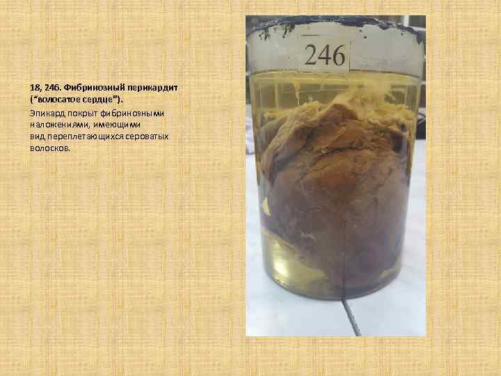 18, 246. Фибринозный перикардит (“волосатое сердце”). Эпикард покрыт фибринозными наложениями, имеющими вид переплетающихся сероватых