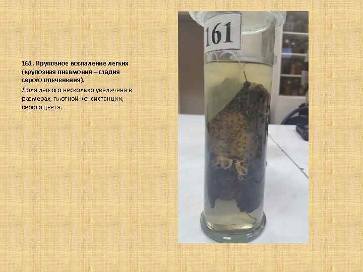 161. Крупозное воспаление легких (крупозная пневмония – стадия серого опеченения). Доля легкого несколько увеличена