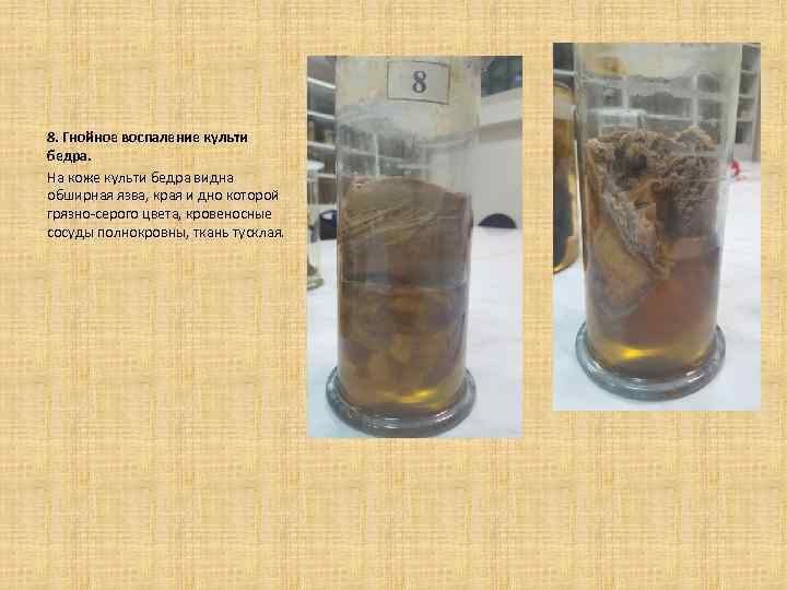 8. Гнойное воспаление культи бедра. На коже культи бедра видна обширная язва, края и