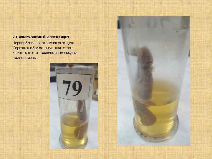 79. Флегмонозный аппендицит. Червеобразный отросток утолщен. Серозная оболочка тусклая, серожелтого цвета, кровеносные сосуды полнокровны.